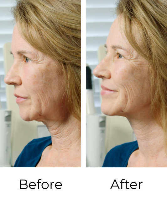 Neck Tape Before and After: Real Results from Real Women