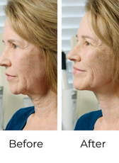 Neck Less - 100 Strips